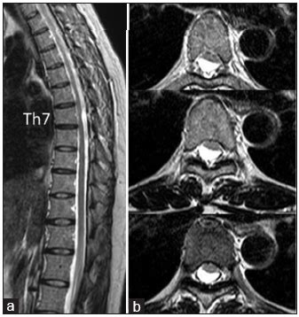 63047 or 63267 since it appears that the synovial cyst is outside the dura. . Spinal synovial cyst icd10